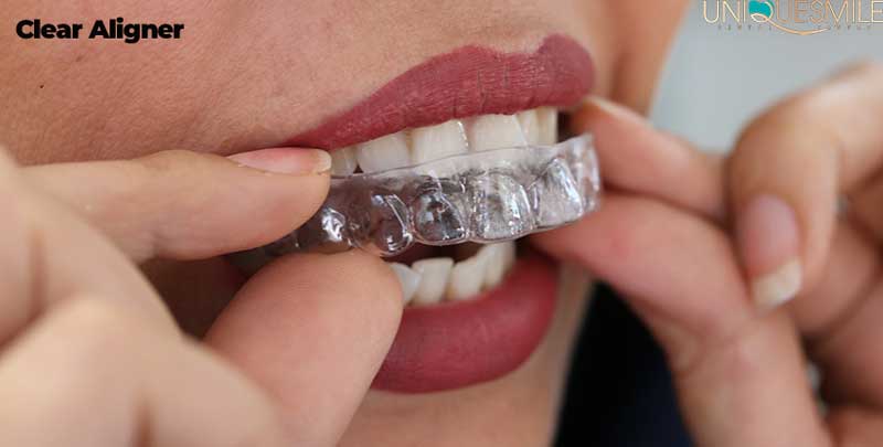 دندانپزشکی زیبایی با ارتودنسی نامرئی